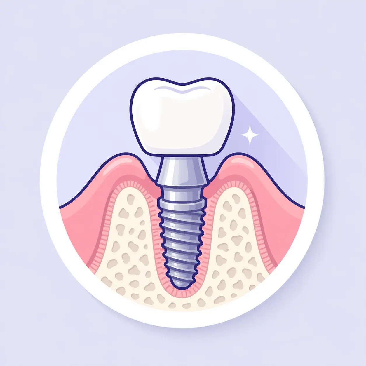 Illustrazione raffigurante il concetto di implantologia dentale